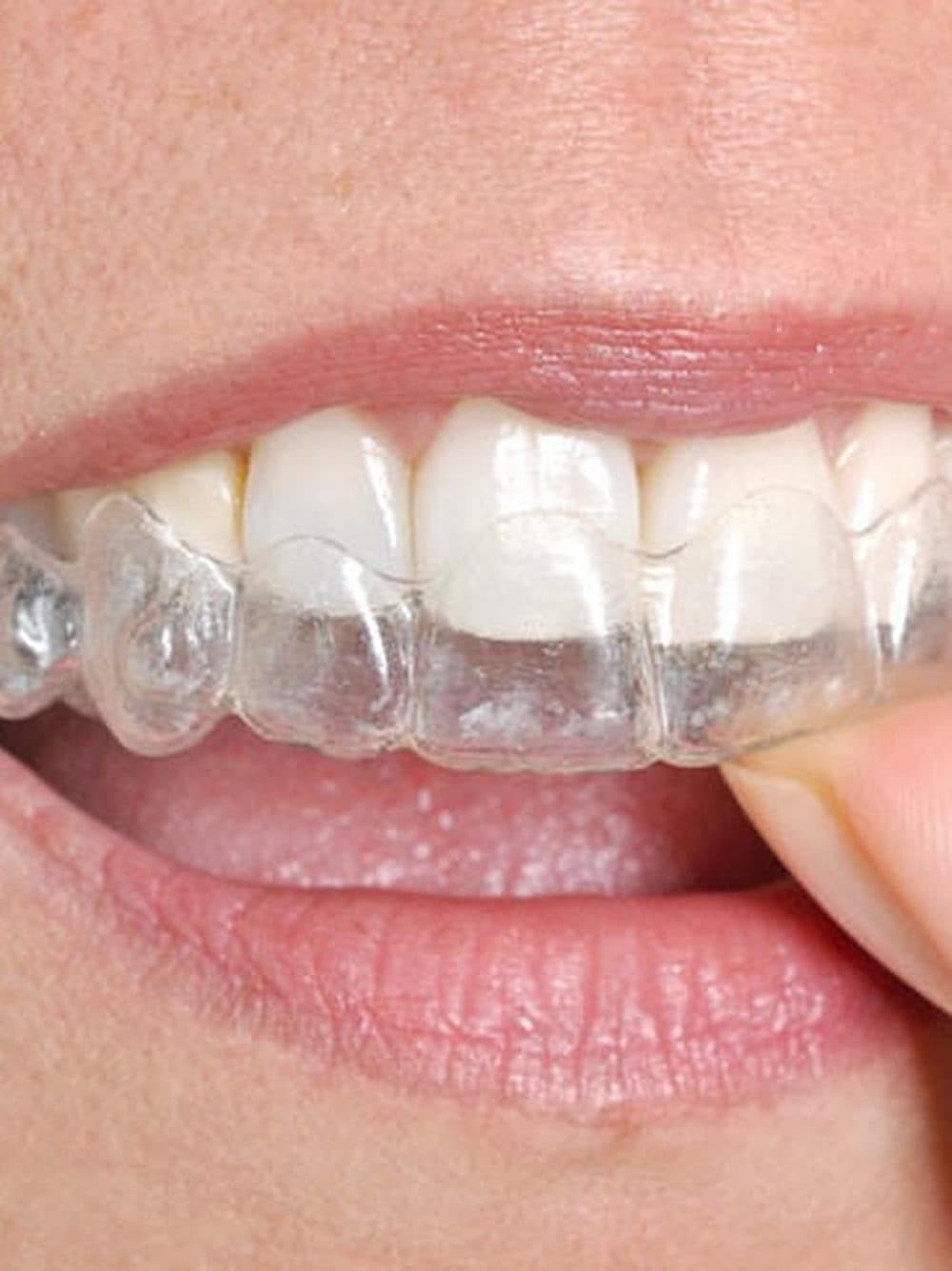 Invisalign
